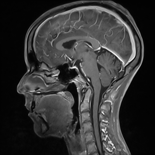 Basilar artery perforator aneurysm (Radiopaedia 82455-97733 G 74).jpg