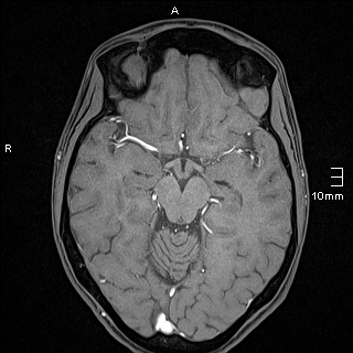 Basilar artery perforator aneurysm (Radiopaedia 82455-99523 F 60).jpg