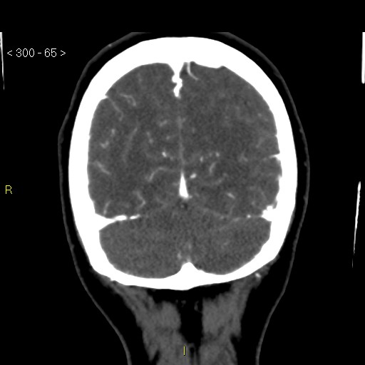File:Basilar artery thrombosis (Radiopaedia 16260-15944 B 56).jpg