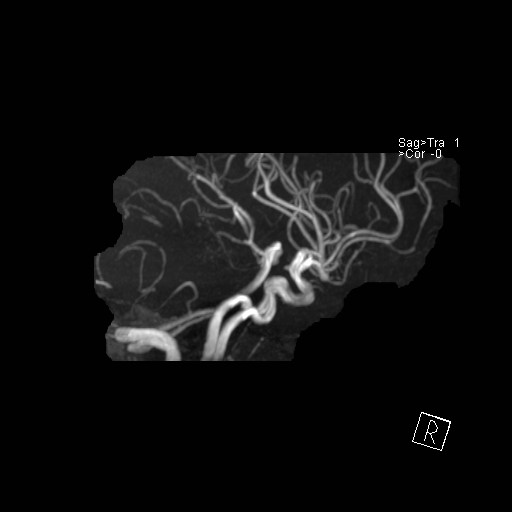 Basilar tip aneurysm (Radiopaedia 26504-26632 D 39).jpg