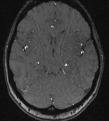 Basilar tip aneurysm (Radiopaedia 26504-26632 MRA 103).jpg