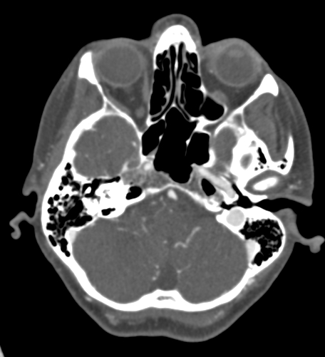 Basilar tip aneurysm with coiling (Radiopaedia 53912-60086 A 35).jpg
