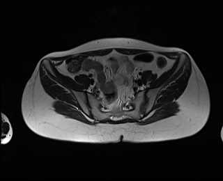 File:Bicornuate bicollis uterus (Radiopaedia 61626-69616 Axial T2 8).jpg