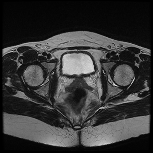 File:Bicornuate uterus (Radiopaedia 51676-57472 Axial T2 13).jpg