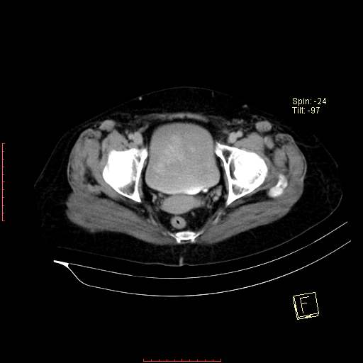 File:Bifid ureter (Radiopaedia 47604-52253 Axial C+ delayed 28).jpg