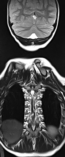 File:Bilateral Sprengel deformity with Klippel-Feil syndrome (Radiopaedia 66395-75650 F 12).jpg