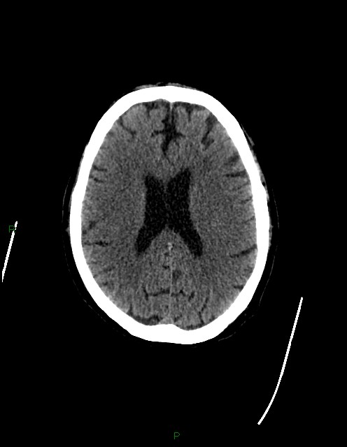 Bilateral acute middle cerebral artery territory infarcts (Radiopaedia 77319-89401 Axial non-contrast 55).jpg