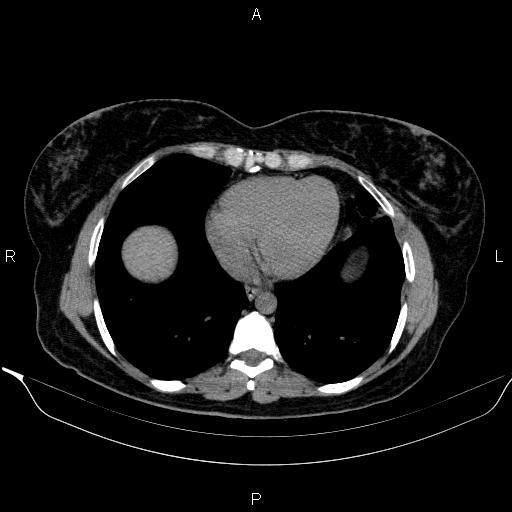 Bilateral adrenal myelolipoma (Radiopaedia 63058-71535 Axial non-contrast 2).jpg