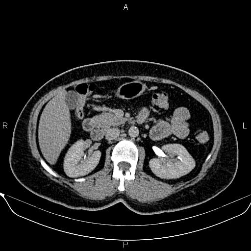 Bilateral benign adrenal adenomas (Radiopaedia 86912-103124 Axial C+ delayed 56).jpg