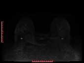File:Bilateral breast implant rupture (Radiopaedia 24761-25027 DWI 13).jpg