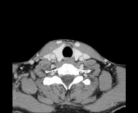 Bilateral carotid body tumors (Radiopaedia 61841-69870 Axial Post contrast 90).jpg