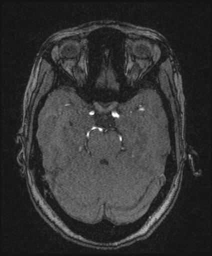 Bilateral carotid body tumors and right glomus jugulare tumor (Radiopaedia 20024-20060 Axial MRA 65).jpg