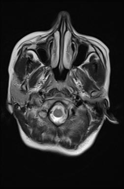 File:Bilateral carotid body tumors and right jugular paraganglioma (Radiopaedia 20024-20060 Axial 63).jpg