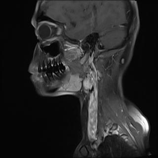 File:Bilateral carotid body tumors and right jugular paraganglioma (Radiopaedia 20024-20060 Sagittal 15).jpg