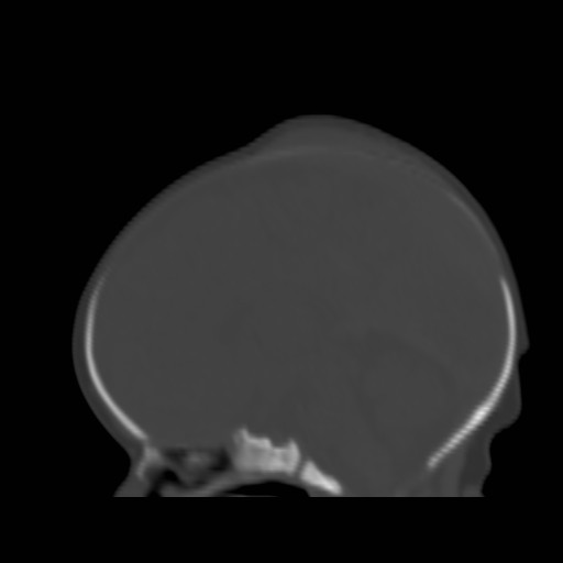 File:Bilateral cephalohematomas and subdural hematomas (Radiopaedia 26778-26929 Sagittal bone window 22).jpg