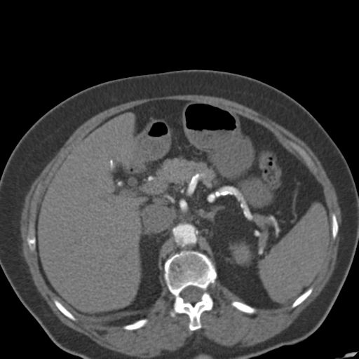 File:Bilateral delayed nephrogram from renal artery stenosis (Radiopaedia 47681-52362 A 18).png