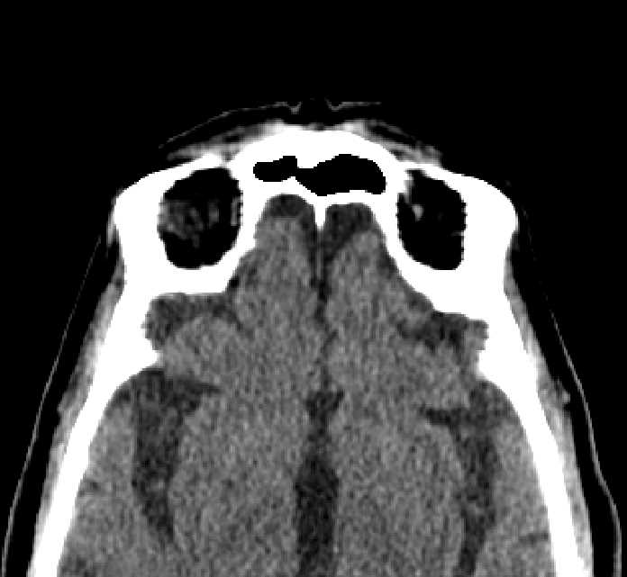 Bilateral ectopia lentis (Radiopaedia 89889-107013 Axial non-contrast 8).jpg