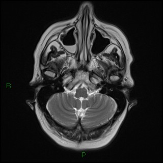 File:Bilateral frontal mucoceles (Radiopaedia 82352-96455 Axial T2 3).jpg