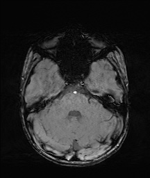 Bilateral mesial temporal polymicrogyria (Radiopaedia 76456-88181 Axial SWI 16).jpg
