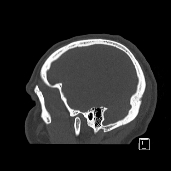 Bilateral occipital condyle fracture (type 2) (Radiopaedia 87675-104089 Sagittal bone window 7).jpg