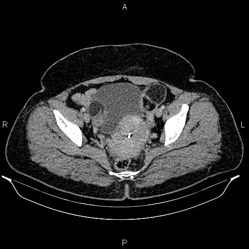 Bilateral ovarian dermoid cysts (Radiopaedia 85785-101603 A 94).jpg