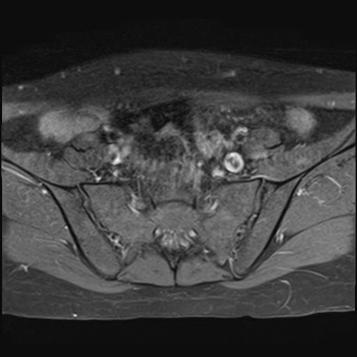 File:Bilateral ovarian endometriomas (Radiopaedia 87085-103347 Axial T1 C+ fat sat 4).jpg
