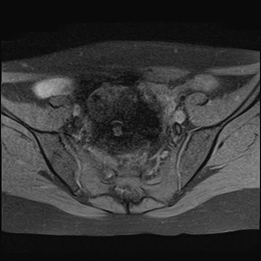 File:Bilateral ovarian endometriomas (Radiopaedia 87085-103347 Axial T1 fat sat 6).jpg