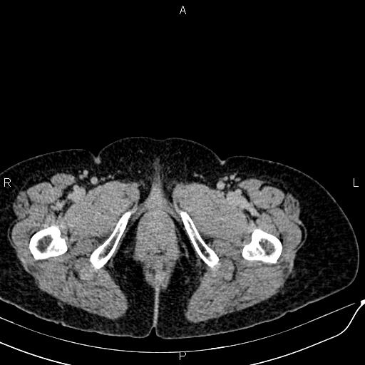 Bilateral ovarian serous cystadenocarcinoma (Radiopaedia 86062-101989 Axial C+ delayed 91).jpg