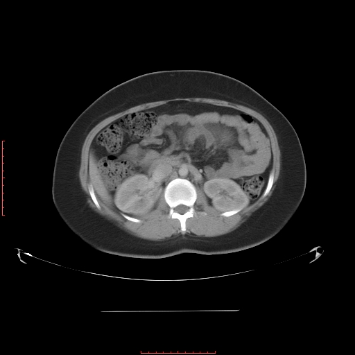 File:Bilateral ovarian serous cystadenocarcinoma with right ovarian torsion (Radiopaedia 32640-33611 A 17).jpg