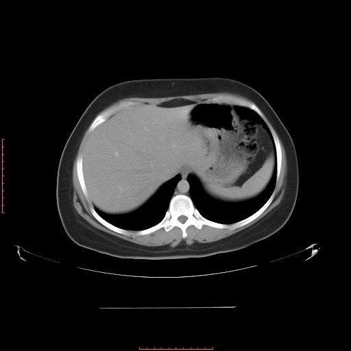 File:Bilateral ovarian serous cystadenocarcinoma with right ovarian torsion (Radiopaedia 32640-33611 A 7).jpg
