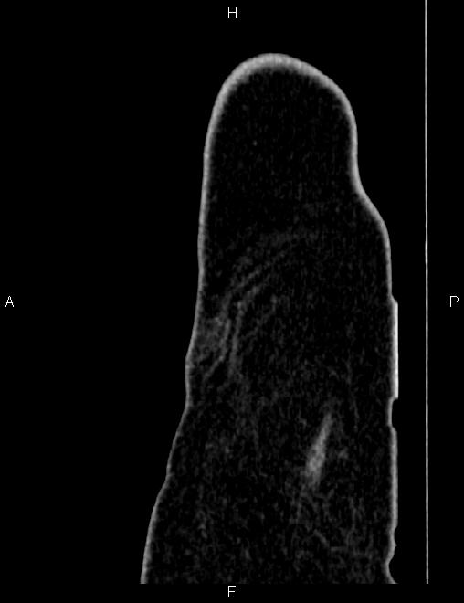 Bilateral ovarian teratoma (Radiopaedia 83131-97503 D 10).jpg
