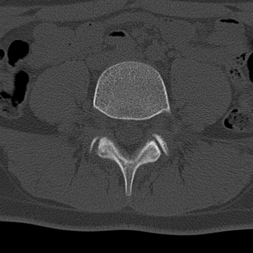 File:Bilateral pars defect (Radiopaedia 26691-26846 Axial bone window 35).jpg