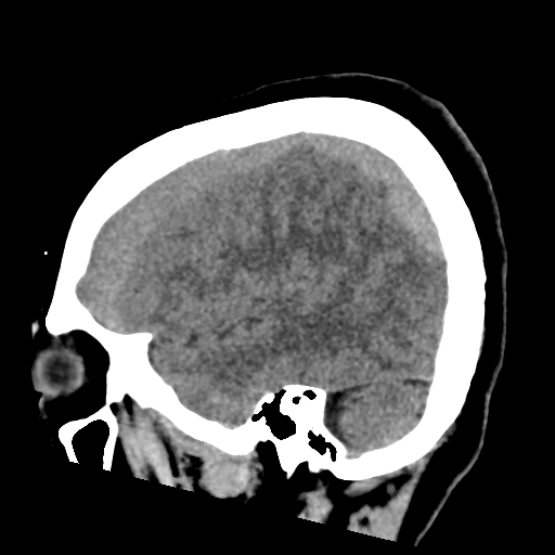 File:Bilateral subacute subdural hematoma (Radiopaedia 69240-79018 C 40).jpg
