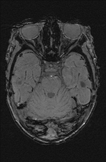 File:Bilateral subdural hemorrhage and parietal skull fracture (Radiopaedia 26058-26190 Axial SWI 20).png