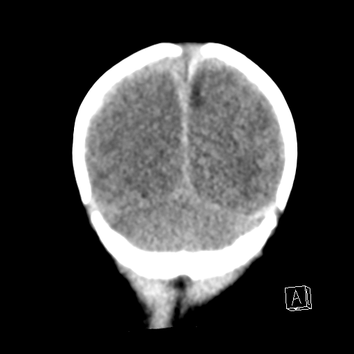 File:Bilateral subdural hemorrhage and parietal skull fracture (Radiopaedia 26058-26192 Coronal non-contrast 24).png