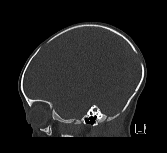 Bilateral subdural hemorrhage and parietal skull fracture (Radiopaedia 26058-26192 Sagittal bone window 25).png