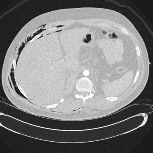 Bilateral traumatic renovascular injury (Radiopaedia 32051-32995 Axial lung window 50).jpg
