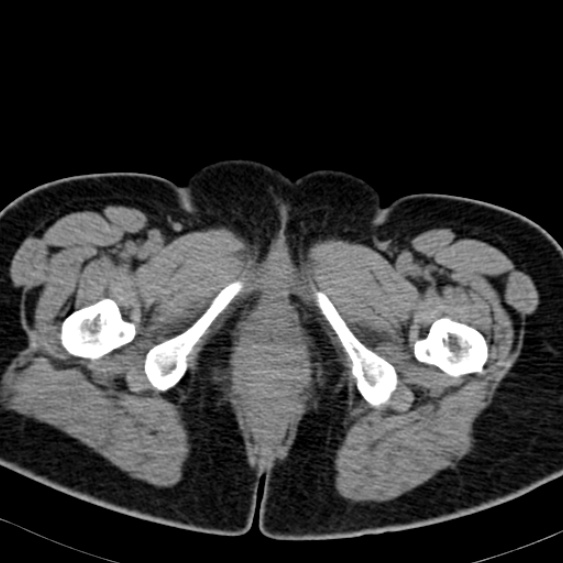 Bilateral ureteric stents (Radiopaedia 48795-53825 Axial non-contrast 74).jpg