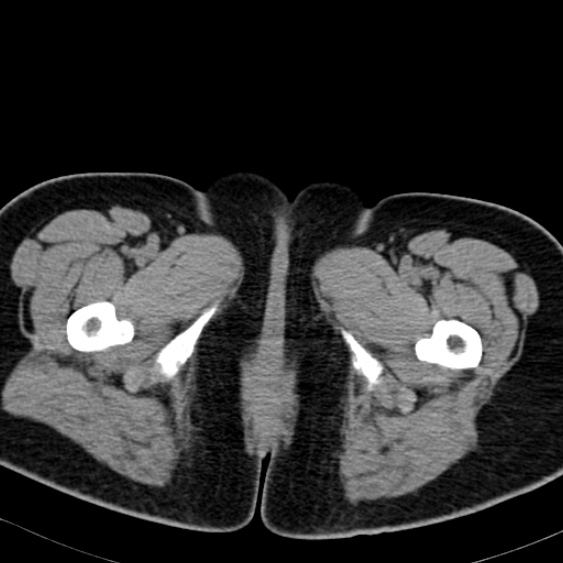 Bilateral ureteric stents (Radiopaedia 48795-53825 Axial non-contrast 76).jpg