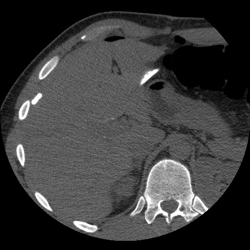 Bile leak from liver traumatic laceration (Radiopaedia 63463-72077 Axial Biliscopin 35).jpg