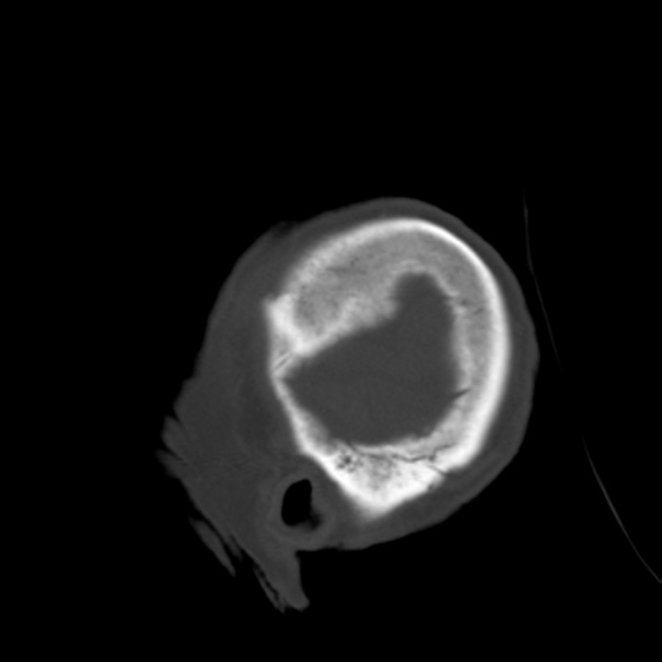 Biparietal osteodystrophy (Radiopaedia 46109-50463 Sagittal bone window 10).jpg
