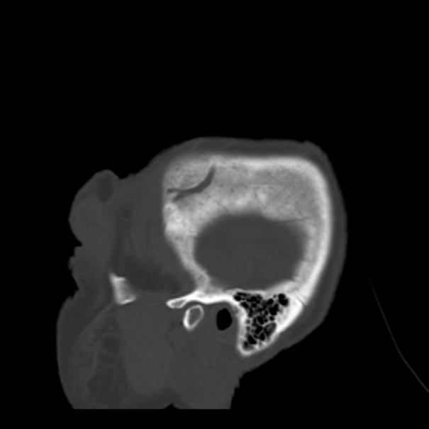 Biparietal osteodystrophy (Radiopaedia 46109-50463 Sagittal bone window 95).jpg