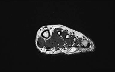 Bipartite hallux sesamoid diastasis (Radiopaedia 77133-89109 Coronal PD 20).jpg