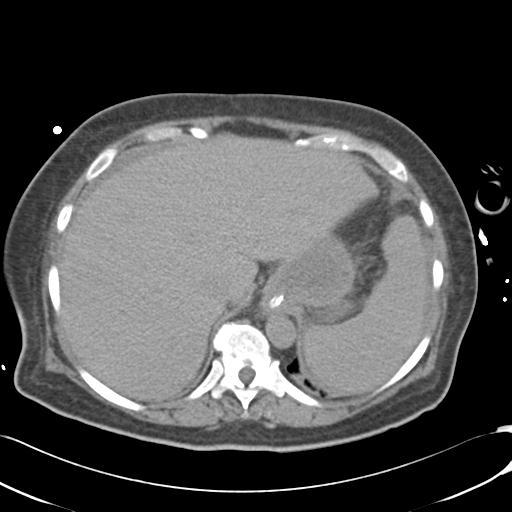 Bladder rupture post renal biopsy (Radiopaedia 30863-31572 Axial non-contrast 16).jpg