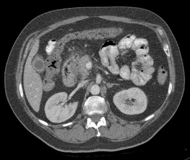 Bleeding duodenal ulcer and adenomyomatosis of gallbladder (Radiopaedia 61834-69861 A 42).jpg