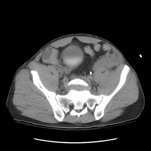 Blunt abdominal trauma with solid organ and musculoskelatal injury with active extravasation (Radiopaedia 68364-77895 Axial C+ delayed 107).jpg