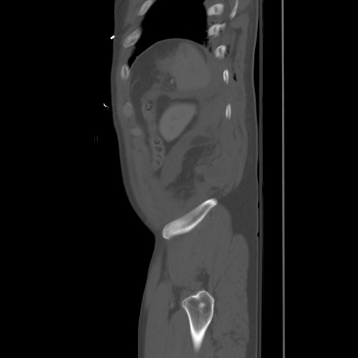 Blunt abdominal trauma with solid organ and musculoskelatal injury with active extravasation (Radiopaedia 68364-77895 Sagittal bone window 98).jpg