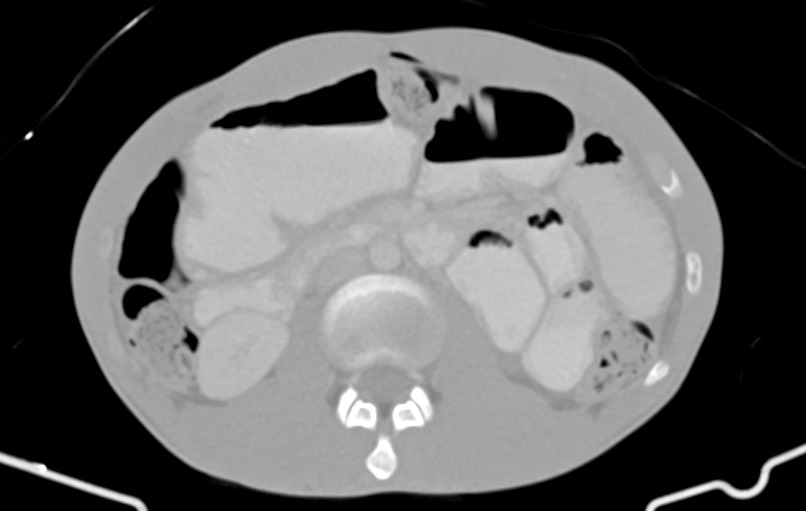 Blunt injury to the small bowel (Radiopaedia 74953-85987 Axial Wide 37).jpg