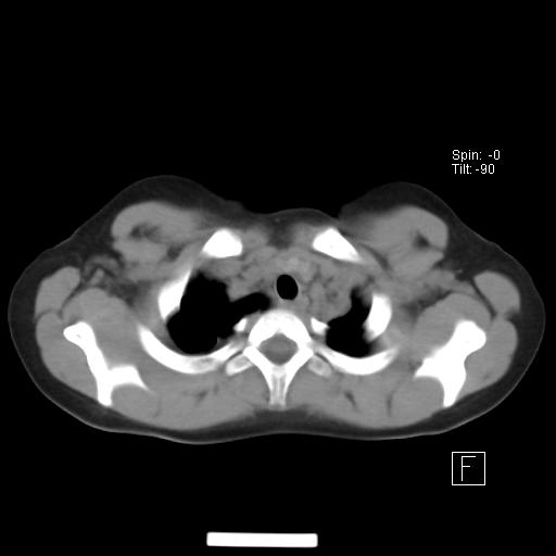 File:Bochdalek diaphragmatic hernia (Radiopaedia 38866-41059 A 3).jpg