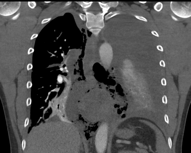 File:Boerhaave syndrome (Radiopaedia 39382-41660 C 56).png